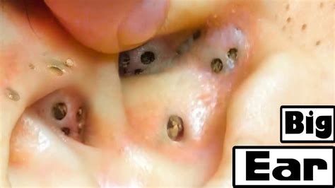 Deep Removal Of Blackheads In The Ear - YouTube