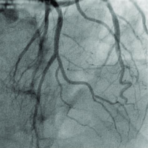 Selective left coronary angiogram documenting excellent final... | Download Scientific Diagram