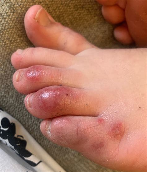 'COVID toes,' other rashes latest possible rare virus signs | AP News