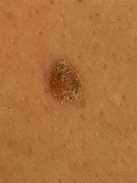 Does this crusty mole on my husbands back look like cancer to you? : r/DermatologyQuestions