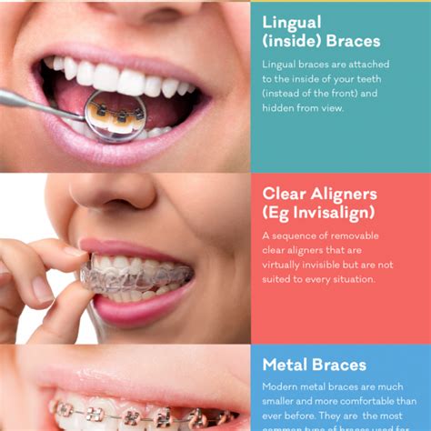 types of braces info straighten teeth without braces | Straighten teeth ...