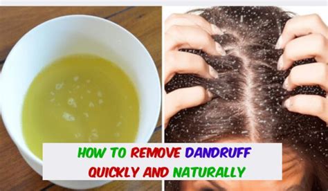 How to Remove Dandruff Quickly And Naturally