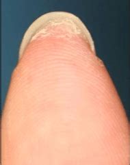 Hyponychium issues! - Rebecca Orme Nail Pro