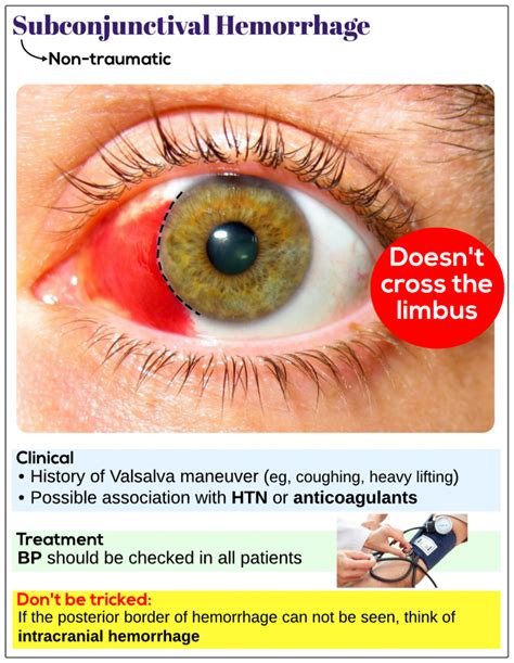 Subconjunctival hemorrhage (non-traumatic) - Medicine Keys for MRCPs