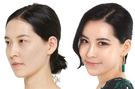 korean plastic surgery procedures Cheaper Than Retail Price> Buy ...