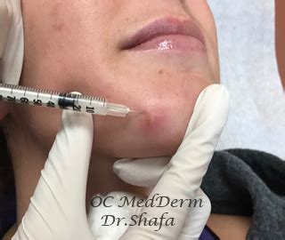 Acne Steroid Injection | OC MedDerm | Irvine & Orange County