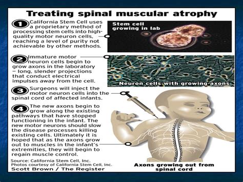 spinal muscular atrophy sma by allelieh