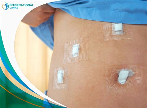 Gastric Sleeve Incisions: What You Need to Know 2023 - International ...