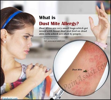 84 Cool How To Treat Dust Mites On Skin - insectza