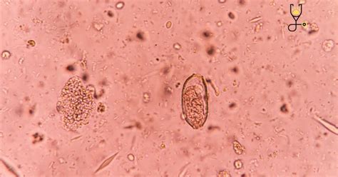 Equine Protozoal Myeloencephalitis (EPM)in Horses-Symptoms, Causes, Treatment, and Prevention ...