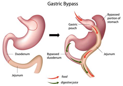 Gastric Bypass Surgery St. Louis, MO | Laparoscopic Gastric Bypass Surgery