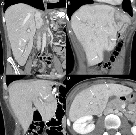 Congestive hepatopathy | SpringerLink