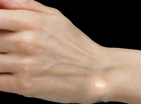 Ganglion Cyst | Treatment & Management | Point of Care