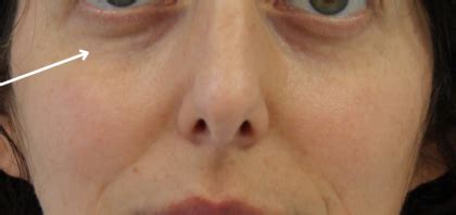 Patient #14263 Dark Under Eye Circles Before and After Photos Santa Monica - Plastic Surgery ...