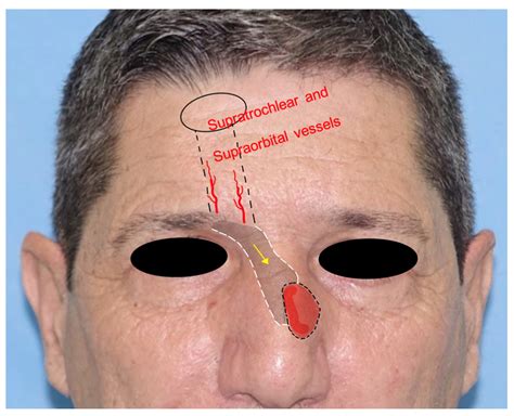 The frontal hairline island flap, with evidence of the vascular... | Download Scientific Diagram