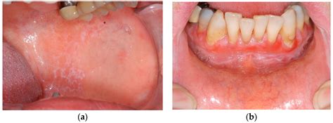 Oral Erosive Lichen Planus