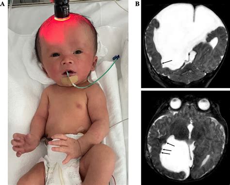 Diagnosis of hydrocephalus by cranial transillumination | ADC Fetal & Neonatal Edition