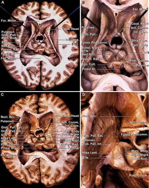 Microsurgical anatomy of the subthalamic nucleus: correlating fiber ...