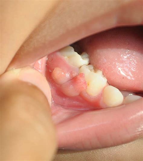 Gum Boils: Causes, Categorization, Symptoms, And Treatment, 58% OFF