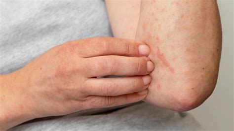 Noticing red & prickly bumps on skin? It can be Urticaria; know causes ...