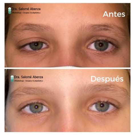 Ptosis palpebral congénita con círugía de resección de aponeurosis ...