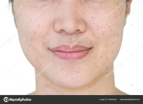Burn Spots Scabs Laser Treatment Acne Skin Freckles Freckles Dark — Stock Photo © nirutdps ...