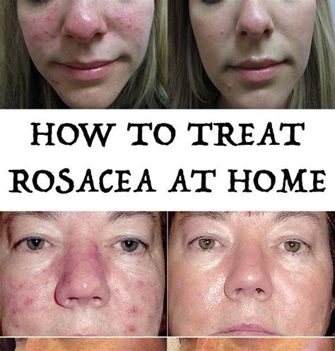 Discover the little-known (but extremely powerful) natural remedy for rosacea, effective natural ...