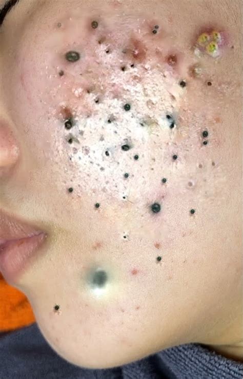 Dr Sandra Lee Blackheads 206