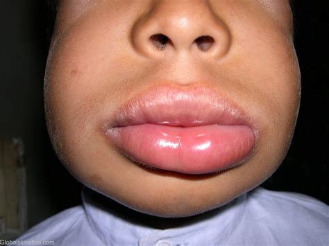 Angioedema Of The Lips Pictures | Lipstutorial.org