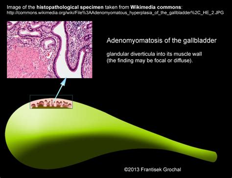 📃 Adenomyomatosis of the gallbladder