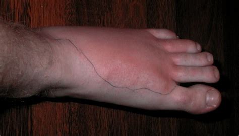 Infected Blister? How To Tell & What To Do About It - Blister Prevention