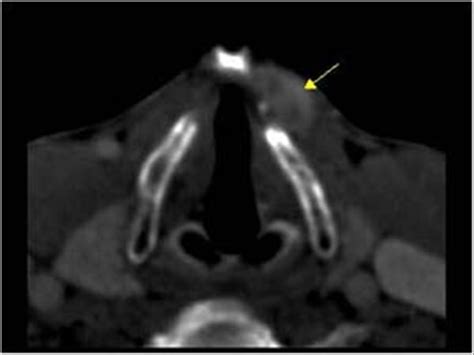 Head and Neck | 4.1 Thyroid gland : Case 4.1.1 Thyroid congenital abnormalities | Ultrasound Cases