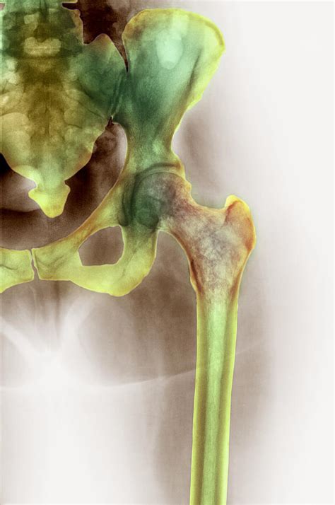 Osteoporosis Of The Hip, X-ray Photograph by