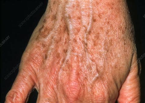 Lentigo: liver spots on a 53-year-old woman's hand - Stock Image - M200/0121 - Science Photo Library