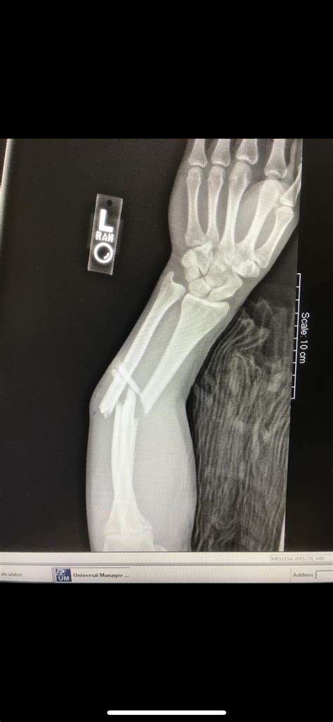 Compound fracture from a skateboarding accident : r/medizzy