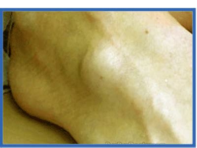 Ganglion Cysts - Central Carolina Foot & Ankle Associates