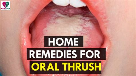 Home Remedies for Oral Thrush - health Sutra - YouTube