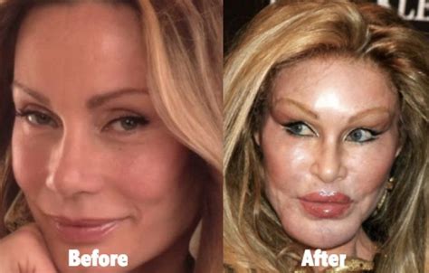 Catwoman Plastic Surgery Gone Wrong 53 celebrity plastic surgery gone ...