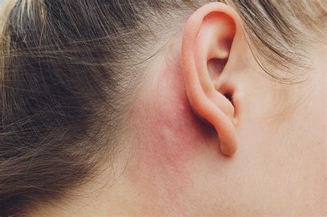 Ear Eczema: Symptoms, Causes, Diagnosis, Treatment, Warning, 51% OFF