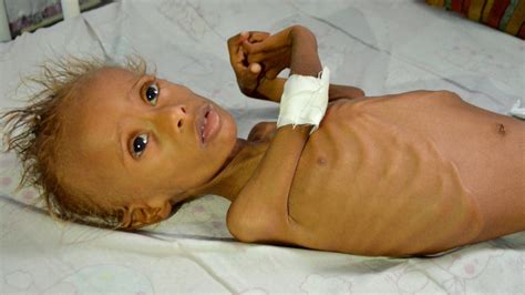 UN Report: 7 Million In Yemen On Verge Of Starvation