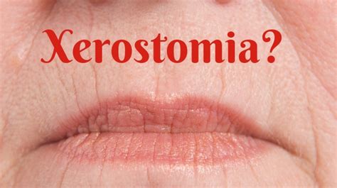 Xerostomia Treatment