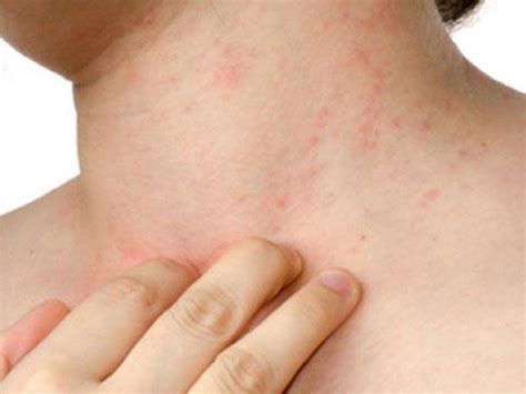 Identifying Skin Rashes Treatment