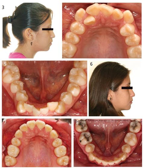 Guest Editorial: Orthodontic Extraction Therapy: A Hard Look At the ...