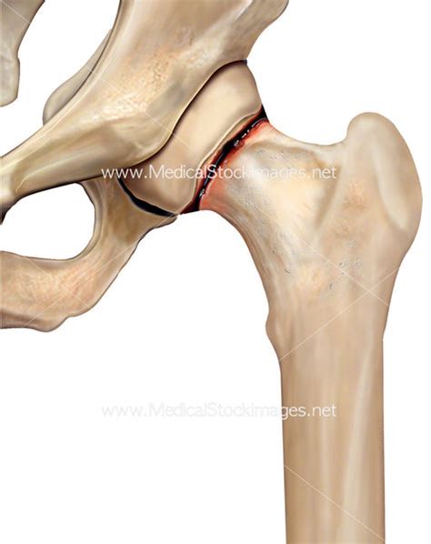 Hip Subcapital Fracture – Medical Stock Images Company