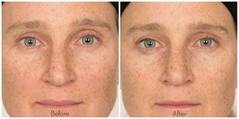 The Effects of Vitamin C on Your Skin | BeautyRx by Dr. Schultz