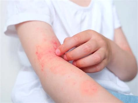 What children with atopic dermatitis should eat and should not - FamousPHD