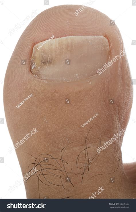 Tinea Unguium Isolated Stock Photo 660396697 | Shutterstock