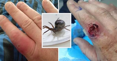 False widow spider bite 'nearly cost joiner his finger' - as he watched ...