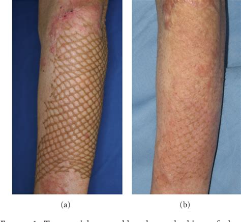 [PDF] Treatment of Mesh Skin Grafted Scars Using a Plasma Skin ...