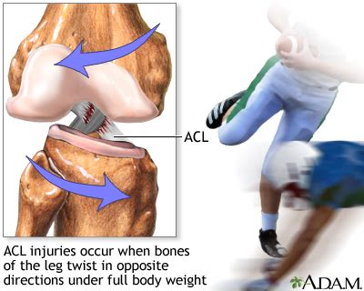 HIE Multimedia - Anterior cruciate ligament (ACL) injury